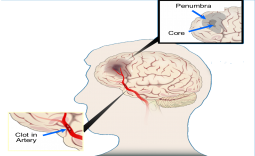 XỬ TRÍ ĐỘT QUỴ NÃO CẤP